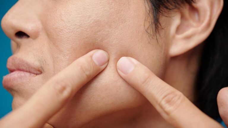 擠暗瘡險送命？浙江大學生慘痛經歷：肺部穿孔十多個洞！