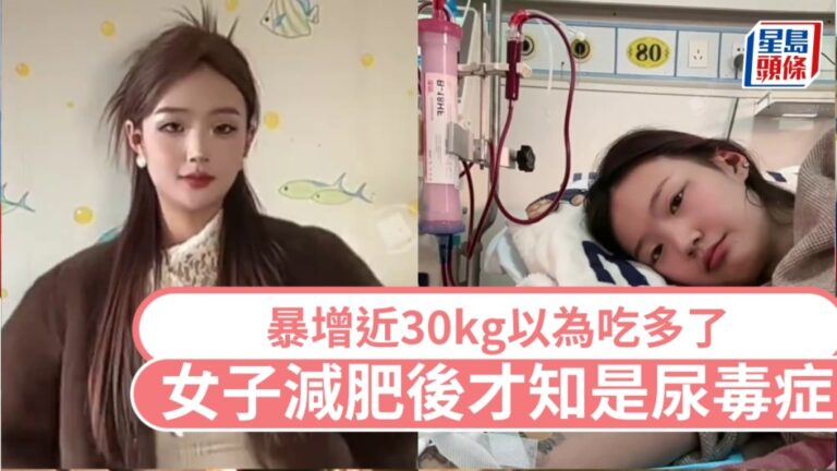 體重暴增30kg以為食太多 24歲女減肥後竟確診尿毒症