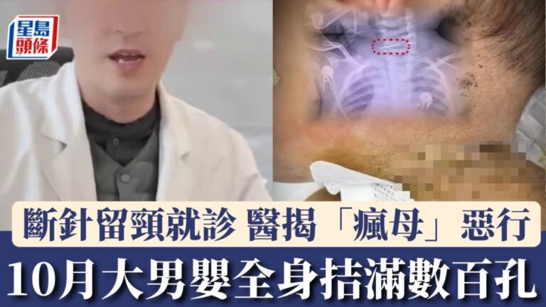 雲南10月大男嬰遭母拮數百針放血 頸椎斷針驚動醫護報警