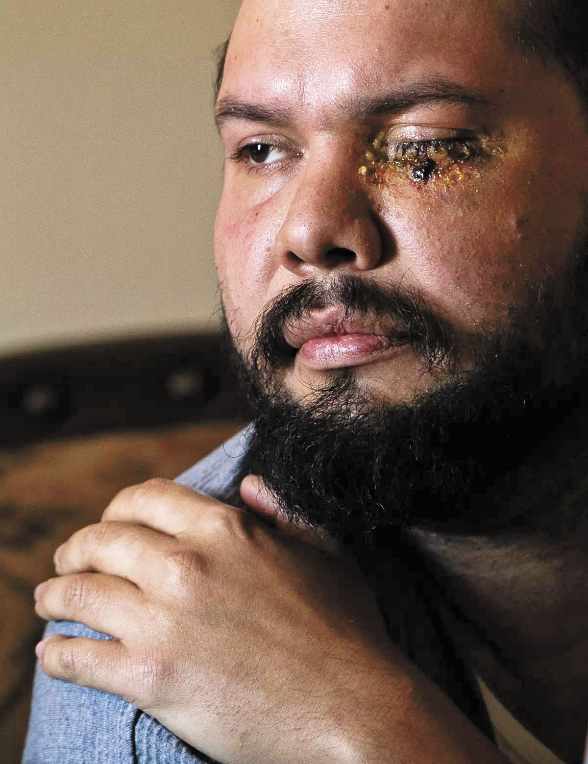 橙縣反ICE示威傷者憶述爆眼經歷