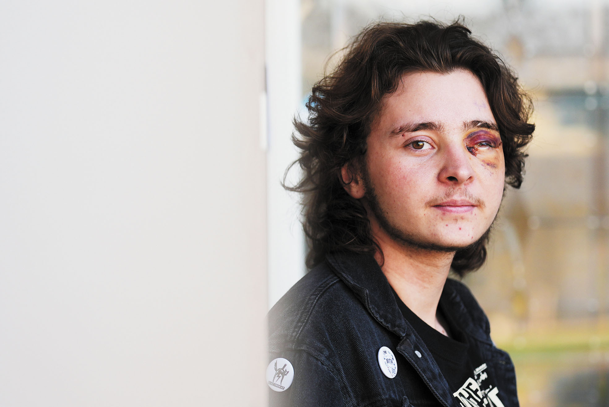 21歲的魯姆勒左眼失去視力。美聯社