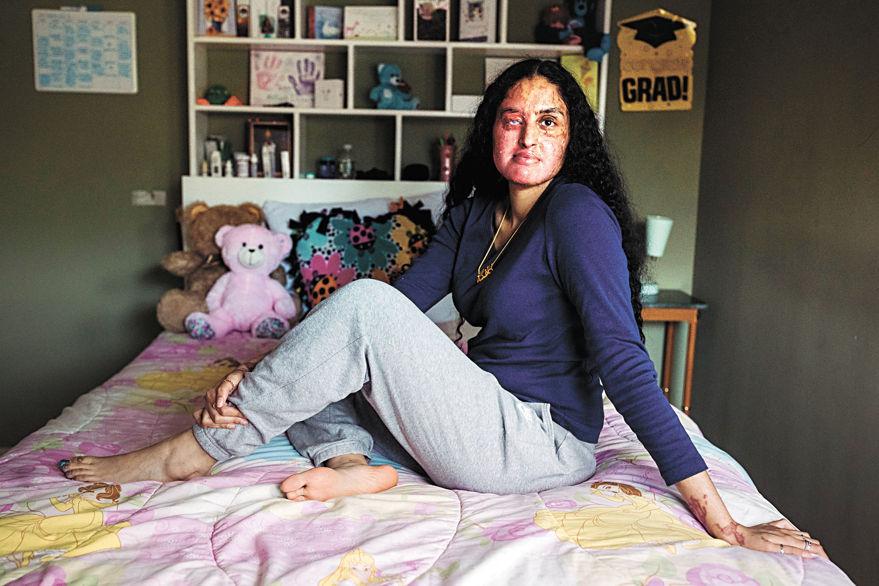 受害人伊克拉姆被潑強酸致毀容。 Sara Naomi Lewkowicz/紐約時報