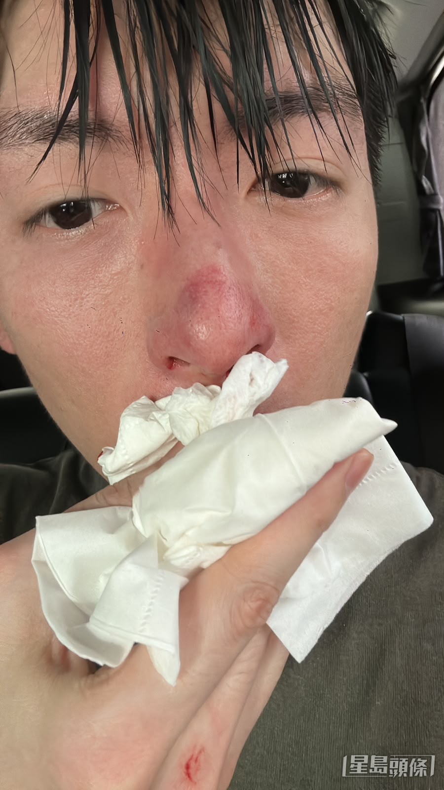 譚坤倫在拍攝時被對手揮拳擊中鼻部。（獨家圖片）