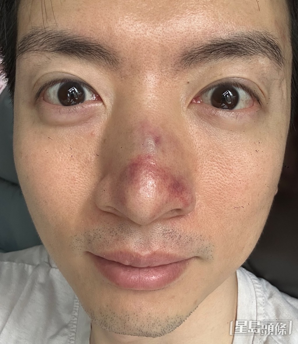 譚坤倫在意外後送院，檢查結果顯示鼻骨骨折。（獨家圖片）